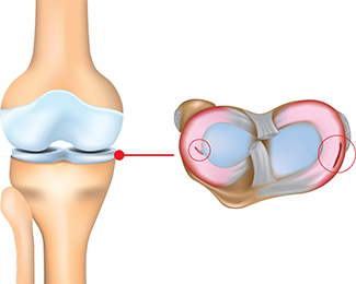 반월상연골 손상