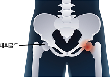 대퇴골두 무혈성 괴사