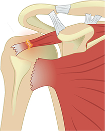 회전근개 파열