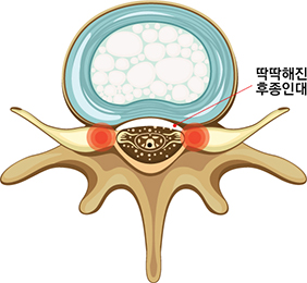 후종인대 횡단면