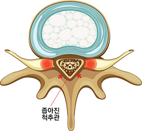 협착증 횡단면