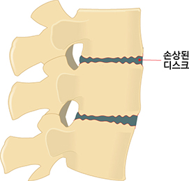 손상된 디스크